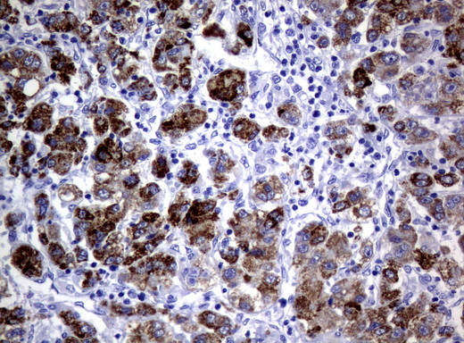 AMACR / P504S Antibody - Immunohistochemical staining of paraffin-embedded Carcinoma of Human liver tissue using anti-AMACR mouse monoclonal antibody.  heat-induced epitope retrieval by 10mM citric buffer, pH6.0, 120C for 3min)