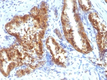 AMACR / P504S Antibody - Formalin-fixed, paraffin-embedded human prostate carcinoma stained with AMACR antibody.  This image was taken for the unmodified form of this product. Other forms have not been tested.