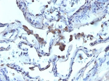 AMACR / P504S Antibody - Formalin-fixed, paraffin-embedded human lung carcinoma stained with AMACR antibody.  This image was taken for the unmodified form of this product. Other forms have not been tested.