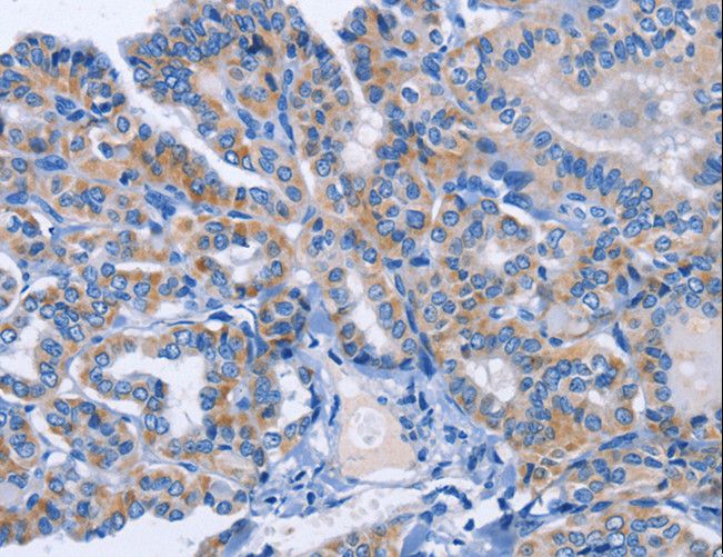 AMACR / P504S Antibody - Immunohistochemistry of paraffin-embedded Human thyroid cancer using AMACR Polyclonal Antibody at dilution of 1:30.