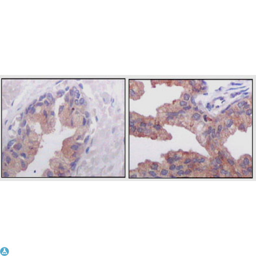 AMACR / P504S Antibody - Immunohistochemistry (IHC) analysis of paraffin-embedded human normal prostate tissues (left) and prostate adenocarcinoma tissues (right), showing cytoplasmic localization with DAB staining using AMACR Monoclonal Antibody.