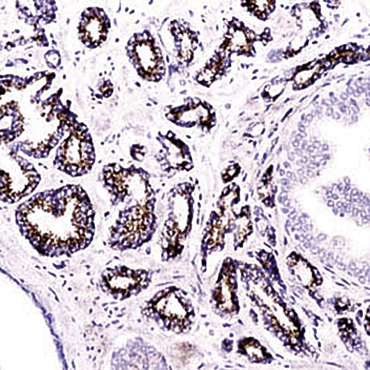 AMACR / P504S Antibody - Formalin-fixed, paraffin-embedded human prostate carcinoma stained with P504S antibody.