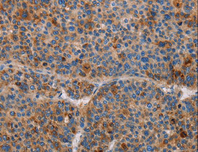 AMBP  Antibody - Immunohistochemistry of paraffin-embedded Human liver cancer using AMBP Polyclonal Antibody at dilution of 1:55.