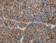 AMBP  Antibody - Immunohistochemistry of paraffin-embedded Human liver cancer using AMBP Polyclonal Antibody at dilution of 1:55.