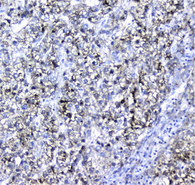 AMBP  Antibody - IHC analysis of Alpha 1 microglobulin using anti-Alpha 1 microglobulin antibody. Alpha 1 microglobulin was detected in paraffin-embedded section of human liver cancer tissue. Heat mediated antigen retrieval was performed in citrate buffer (pH6, epitope retrieval solution) for 20 mins. The tissue section was blocked with 10% goat serum. The tissue section was then incubated with 2µg/ml rabbit anti-Alpha 1 microglobulin Antibody overnight at 4°C. Biotinylated goat anti-rabbit IgG was used as secondary antibody and incubated for 30 minutes at 37°C. The tissue section was developed using Strepavidin-Biotin-Complex (SABC) with DAB as the chromogen.