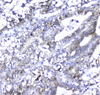 AMBP  Antibody - IHC staining of FFPE human liver cancer with Alpha 1 microglobulin antibody at 1ug/ml. HIER: boil tissue sections in pH6, 10mM citrate buffer, for 10-20 min followed by cooling at RT for 20 min.