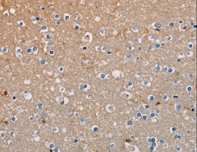 AMBRA1 Antibody - Immunohistochemistry of paraffin-embedded Human liver cancer using AMBRA1 Polyclonal Antibody at dilution of 1:50.