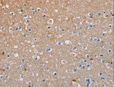 AMBRA1 Antibody - Immunohistochemistry of paraffin-embedded Human liver cancer using AMBRA1 Polyclonal Antibody at dilution of 1:50.