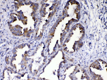 AMD / AMD1 Antibody - IHC testing of FFPE human lung cancer tissue with AMD1 antibody at 1ug/ml. Required HIER: steam section in pH6 citrate buffer for 20 min and allow to cool prior to testing.