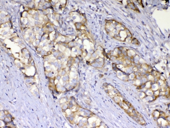 AMD / AMD1 Antibody - IHC testing of FFPE human breast cancer tissue with AMD1 antibody at 1ug/ml. Required HIER: steam section in pH6 citrate buffer for 20 min and allow to cool prior to testing.