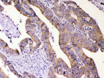 AMD / AMD1 Antibody - IHC testing of FFPE human intestinal cancer tissue with AMD1 antibody at 1ug/ml. Required HIER: steam section in pH6 citrate buffer for 20 min and allow to cool prior to testing.