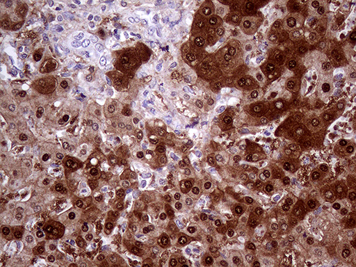 AMDHD1 Antibody - Immunohistochemical staining of paraffin-embedded Carcinoma of Human liver tissue using anti-AMDHD1 mouse monoclonal antibody. (Heat-induced epitope retrieval by 1mM EDTA in 10mM Tris buffer. (pH8.5) at 120°C for 3 min. (1:2000)