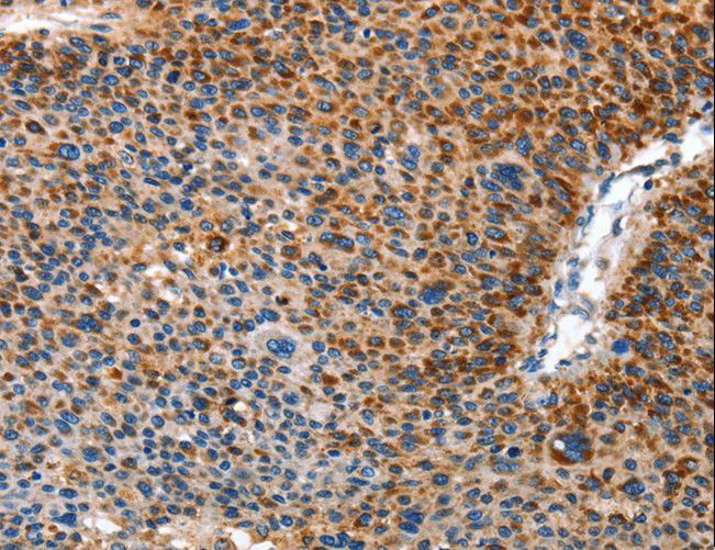 AMDHD2 Antibody - Immunohistochemistry of paraffin-embedded Human liver cancer using AMDHD2 Polyclonal Antibody at dilution of 1:40.