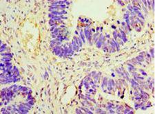 AMH / Anti-Mullerian Hormone Antibody - Immunohistochemistry of paraffin-embedded human ovarian cancer using antibody at 1:100 dilution.  This image was taken for the unconjugated form of this product. Other forms have not been tested.