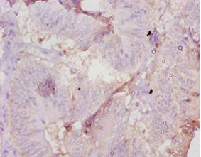 AMH / Anti-Mullerian Hormone Antibody - Immunohistochemistry of paraffin-embedded human colon cancer using Amh Antibody at dilution of 1:10
