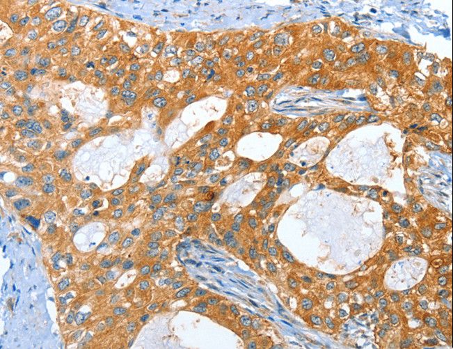 AMHR2 / MISRII Antibody - Immunohistochemistry of paraffin-embedded Human lung cancer using AMHR2 Polyclonal Antibody at dilution of 1:40.