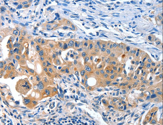 AMHR2 / MISRII Antibody - Immunohistochemistry of paraffin-embedded Human lung cancer using AMHR2 Polyclonal Antibody at dilution of 1:40.