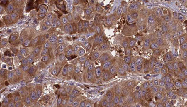 AMICA / JAML Antibody - 1:100 staining human liver carcinoma tissues by IHC-P. The sample was formaldehyde fixed and a heat mediated antigen retrieval step in citrate buffer was performed. The sample was then blocked and incubated with the antibody for 1.5 hours at 22°C. An HRP conjugated goat anti-rabbit antibody was used as the secondary.