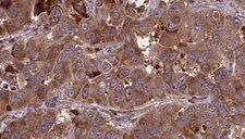 AMICA / JAML Antibody - 1:100 staining human liver carcinoma tissues by IHC-P. The sample was formaldehyde fixed and a heat mediated antigen retrieval step in citrate buffer was performed. The sample was then blocked and incubated with the antibody for 1.5 hours at 22°C. An HRP conjugated goat anti-rabbit antibody was used as the secondary.