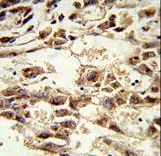 AMID / AIFM2 Antibody - Formalin-fixed and paraffin-embedded human hepatocarcinoma reacted with AIFM2 Antibody , which was peroxidase-conjugated to the secondary antibody, followed by DAB staining. This data demonstrates the use of this antibody for immunohistochemistry; clinical relevance has not been evaluated.