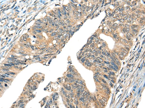 AMID / AIFM2 Antibody - Immunohistochemistry of paraffin-embedded Human colorectal cancer tissue  using AIFM2 Polyclonal Antibody at dilution of 1:40(×200)