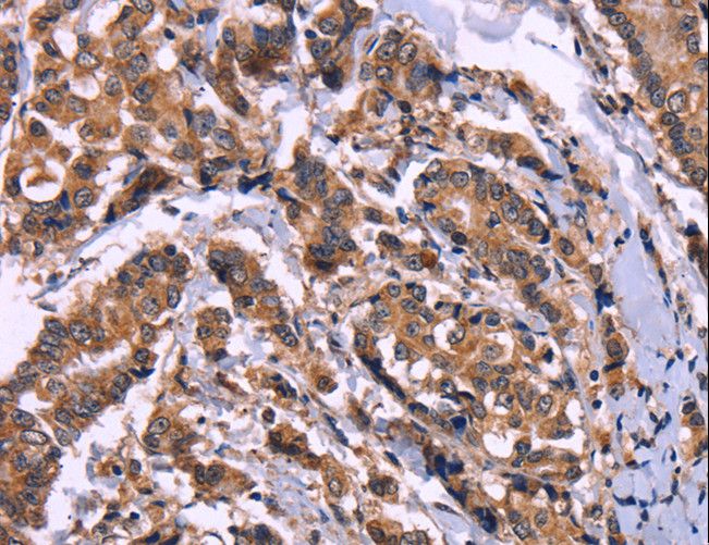 AMIGO2 Antibody - Immunohistochemistry of paraffin-embedded Human breast cancer using AMIGO2 Polyclonal Antibody at dilution of 1:50.