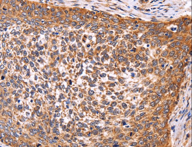 AMIGO2 Antibody - Immunohistochemistry of paraffin-embedded Human cervical cancer using AMIGO2 Polyclonal Antibody at dilution of 1:50.