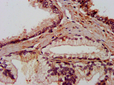 AMIGO2 Antibody - Immunohistochemistry Dilution at 1:800 and staining in paraffin-embedded human prostate cancer performed on a Leica BondTM system. After dewaxing and hydration, antigen retrieval was mediated by high pressure in a citrate buffer (pH 6.0). Section was blocked with 10% normal Goat serum 30min at RT. Then primary antibody (1% BSA) was incubated at 4°C overnight. The primary is detected by a biotinylated Secondary antibody and visualized using an HRP conjugated SP system.