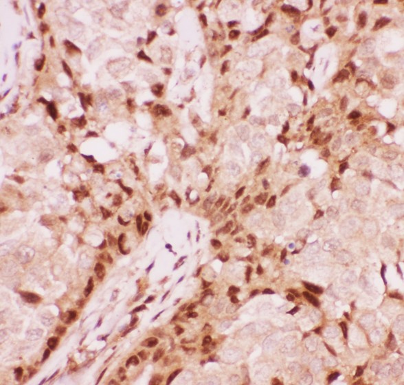 AML1 / RUNX1 Antibody - RUNX1/AML1 antibody IHC-paraffin: Human Mammary Cancer Tissue.