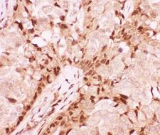 AML1 / RUNX1 Antibody - IHC-P: RUNX1 antibody testing of human breast cancer tissue