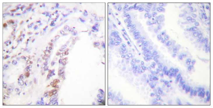 AML1 / RUNX1 Antibody - Immunohistochemistry analysis of paraffin-embedded human lung carcinoma tissue, using AML1 Antibody. The picture on the right is blocked with the synthesized peptide.