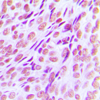 AML1 / RUNX1 Antibody - Immunohistochemical analysis of RUNX1 staining in human breast cancer formalin fixed paraffin embedded tissue section. The section was pre-treated using heat mediated antigen retrieval with sodium citrate buffer (pH 6.0). The section was then incubated with the antibody (1:100) at room temperature and detected using an HRP conjugated compact polymer system. DAB was used as the chromogen. The section was then counterstained with hematoxylin and mounted with DPX.