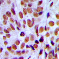 AML1 / RUNX1 Antibody - Immunohistochemical analysis of RUNX1 staining in human breast cancer formalin fixed paraffin embedded tissue section. The section was pre-treated using heat mediated antigen retrieval with sodium citrate buffer (pH 6.0). The section was then incubated with the antibody at room temperature and detected using an HRP polymer system. DAB was used as the chromogen. The section was then counterstained with hematoxylin and mounted with DPX.