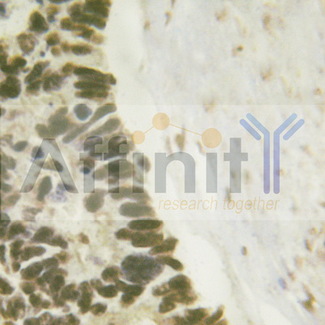 AML1 / RUNX1 Antibody - 1/100 staining human breast  tissue by IHC-P. The sample was formaldehyde fixed and a heat mediated antigen retrieval step in citrate buffer was performed. The sample was then blocked and incubated with the antibody for 1.5 hours at 22°C. An HRP conjugated goat anti-rabbit antibody was used as the secondary antibody.