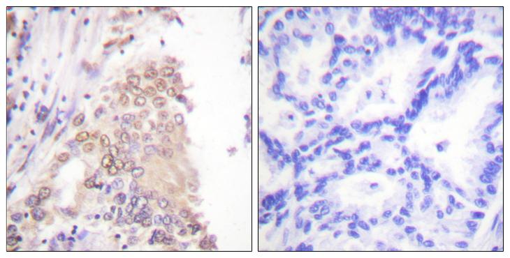 AML1 / RUNX1 Antibody - Peptide - + Immunohistochemistry analysis of paraffin-embedded human lung carcinoma tissue using AML1 (Ab-276) antibody.