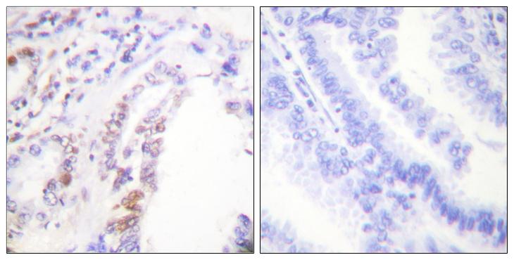 AML1 / RUNX1 Antibody - Peptide - + Immunohistochemistry analysis of paraffin-embedded human lung carcinoma tissue using AML1 (Ab-303) Antibody.