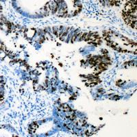 AML1 / RUNX1 Antibody - Immunohistochemical analysis of RUNX1 (pS276) staining in human colon cancer formalin fixed paraffin embedded tissue section. The section was pre-treated using heat mediated antigen retrieval with sodium citrate buffer (pH 6.0). The section was then incubated with the antibody at room temperature and detected using an HRP conjugated compact polymer system. DAB was used as the chromogen. The section was then counterstained with hematoxylin and mounted with DPX.