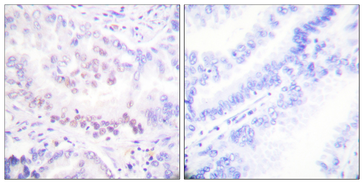 AML1 / RUNX1 Antibody - Immunohistochemistry analysis of paraffin-embedded human lung carcinoma, using AML1 (Phospho-Ser303) Antibody. The picture on the right is blocked with the phospho peptide.