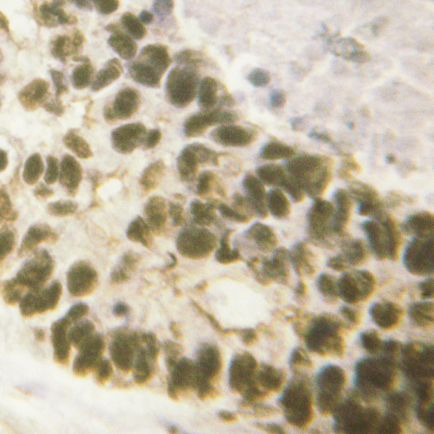 AML1 / RUNX1 Antibody - 1/100 staining human lung tissue by IHC-P. The sample was formaldehyde fixed and a heat mediated antigen retrieval step in citrate buffer was performed. The sample was then blocked and incubated with the antibody for 1.5 hours at 22°C. An HRP conjugated goat anti-rabbit antibody was used as the secondary antibody.