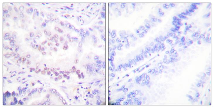AML1 / RUNX1 Antibody - P-peptide - + Immunohistochemical analysis of paraffin-embedded human lung carcinoma tissue using AML1 (Phospho-Ser303) Antibody.