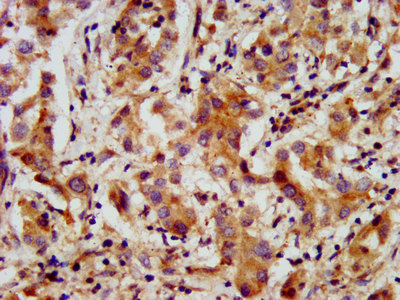 AMMECR1 Antibody - Immunohistochemistry image at a dilution of 1:200 and staining in paraffin-embedded human liver cancer performed on a Leica BondTM system. After dewaxing and hydration, antigen retrieval was mediated by high pressure in a citrate buffer (pH 6.0) . Section was blocked with 10% normal goat serum 30min at RT. Then primary antibody (1% BSA) was incubated at 4 °C overnight. The primary is detected by a biotinylated secondary antibody and visualized using an HRP conjugated SP system.