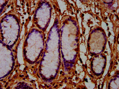 AMN Antibody - Immunohistochemistry Dilution at 1:600 and staining in paraffin-embedded human gastric cancer performed on a Leica BondTM system. After dewaxing and hydration, antigen retrieval was mediated by high pressure in a citrate buffer (pH 6.0). Section was blocked with 10% normal Goat serum 30min at RT. Then primary antibody (1% BSA) was incubated at 4°C overnight. The primary is detected by a biotinylated Secondary antibody and visualized using an HRP conjugated SP system.