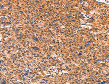AMPD1 Antibody - Immunohistochemistry of paraffin-embedded Human liver cancer using AMPD1 Polyclonal Antibody at dilution of 1:80.