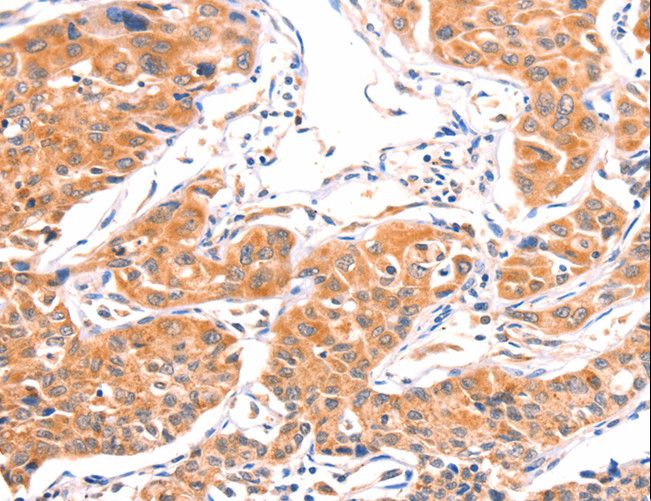 AMPD1 Antibody - Immunohistochemistry of paraffin-embedded Human lung cancer using AMPD1 Polyclonal Antibody at dilution of 1:80.