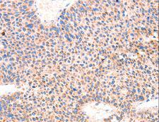 AMPD1 Antibody - Immunohistochemistry of paraffin-embedded Human liver cancer using AMPD1 Polyclonal Antibody at dilution of 1:70.
