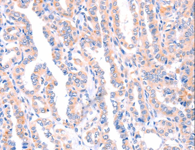AMPD1 Antibody - Immunohistochemistry of paraffin-embedded Human thyroid cancer using AMPD1 Polyclonal Antibody at dilution of 1:70.