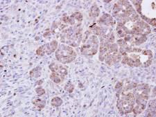 AMPH / Amphiphysin Antibody - IHC of paraffin-embedded NCIN87 xenograft using Amphiphysin antibody at 1:100 dilution.