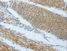 AMPH / Amphiphysin Antibody - Immunohistochemistry of paraffin-embedded Human liver cancer using AMPH Polyclonal Antibody at dilution of 1:25.