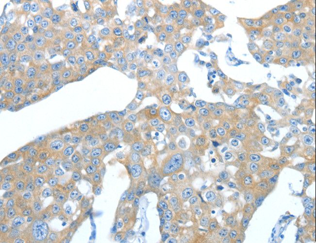 AMPH / Amphiphysin Antibody - Immunohistochemistry of paraffin-embedded Human breast cancer using AMPH Polyclonal Antibody at dilution of 1:25.