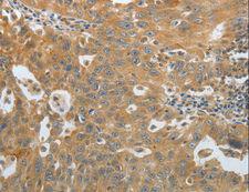 AMPH / Amphiphysin Antibody - Immunohistochemistry of paraffin-embedded Human ovarian cancer using AMPH Polyclonal Antibody at dilution of 1:30.